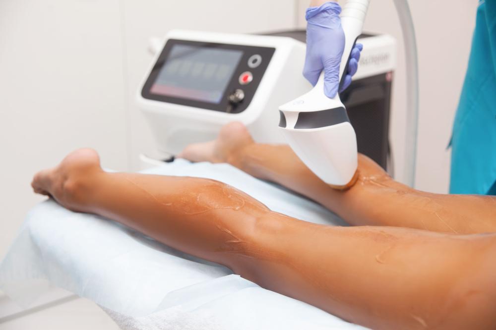 L'épilation définitive par lumière pulsée HTA